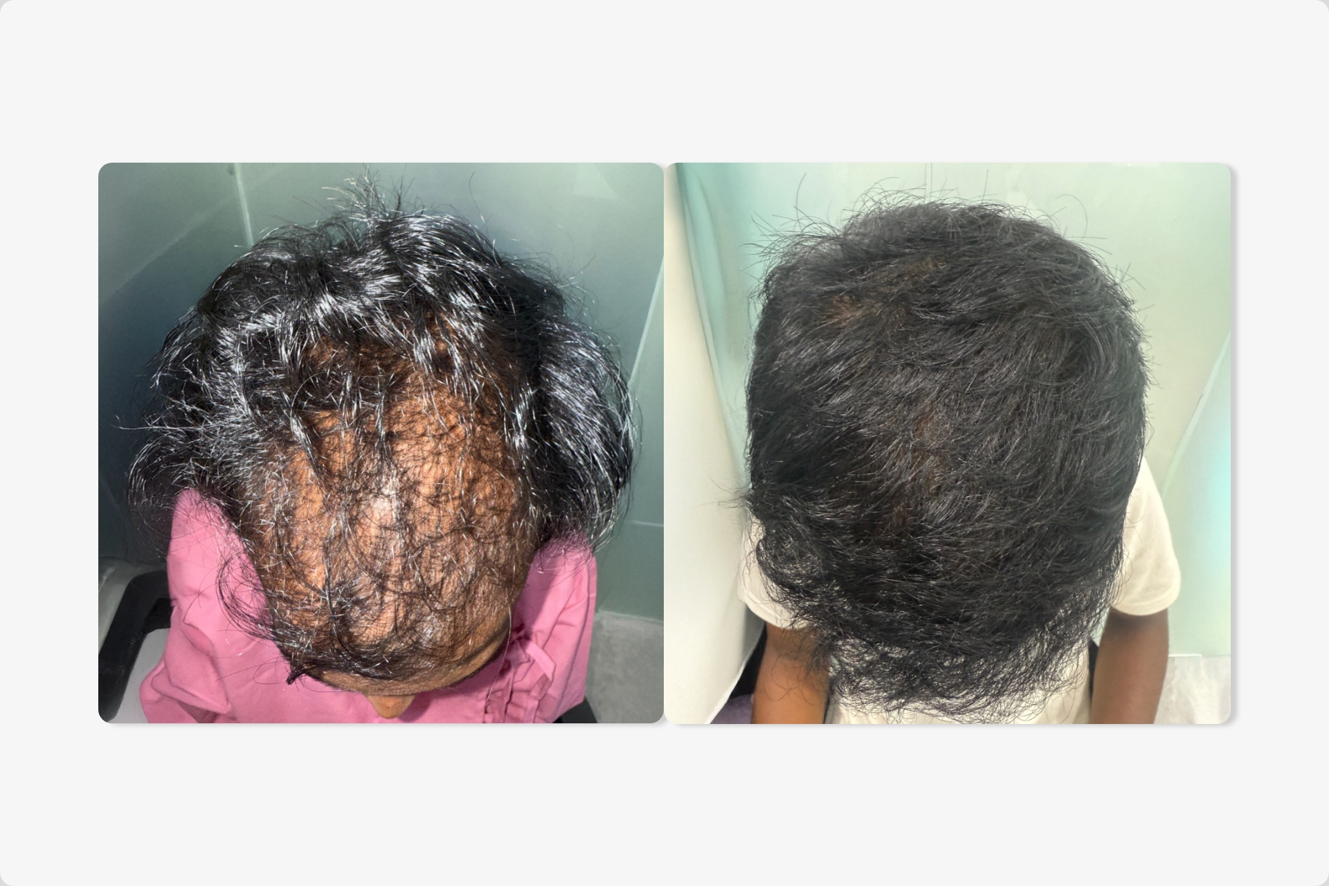 Hair transplant before and after
