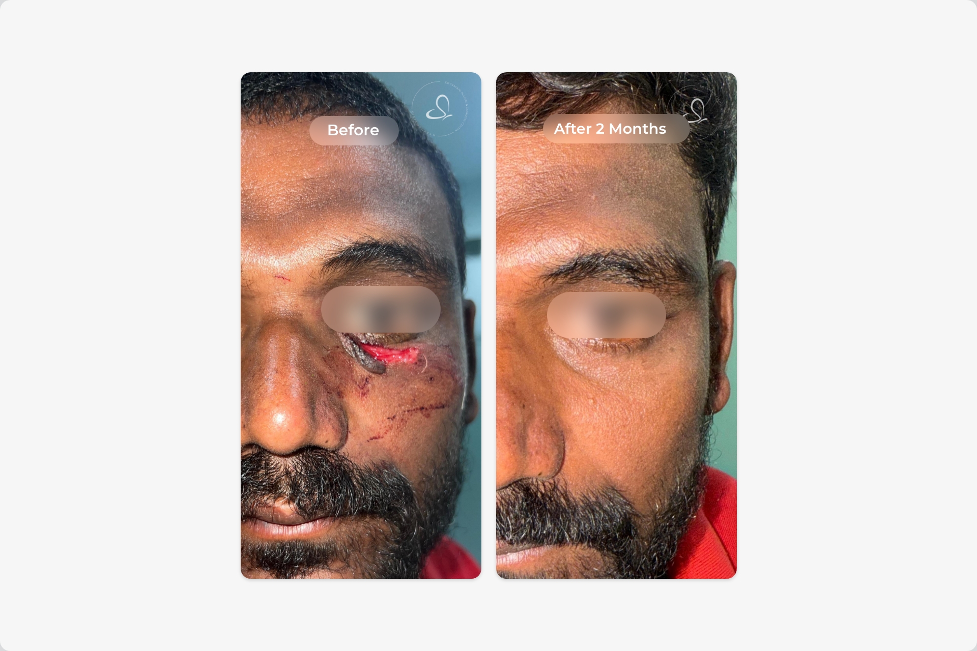 Facial laceration repair before and after
