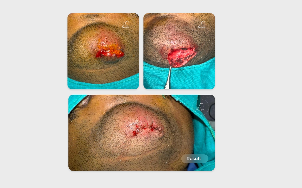 Chin laceration repair before after