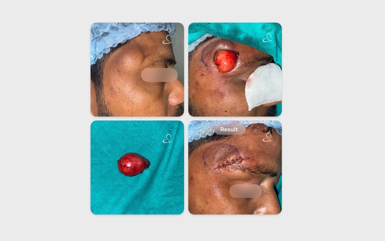 Dermoid cyst excision before after