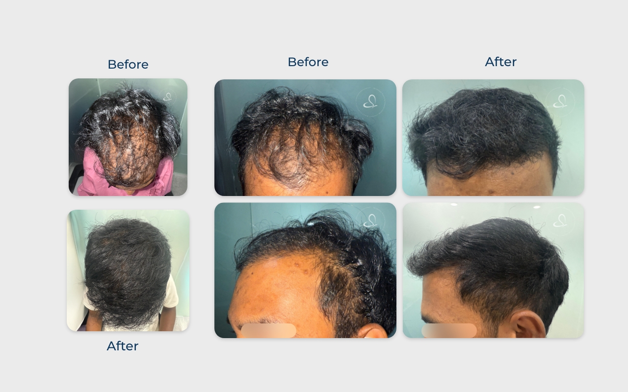 Hair transplant 5 months result
