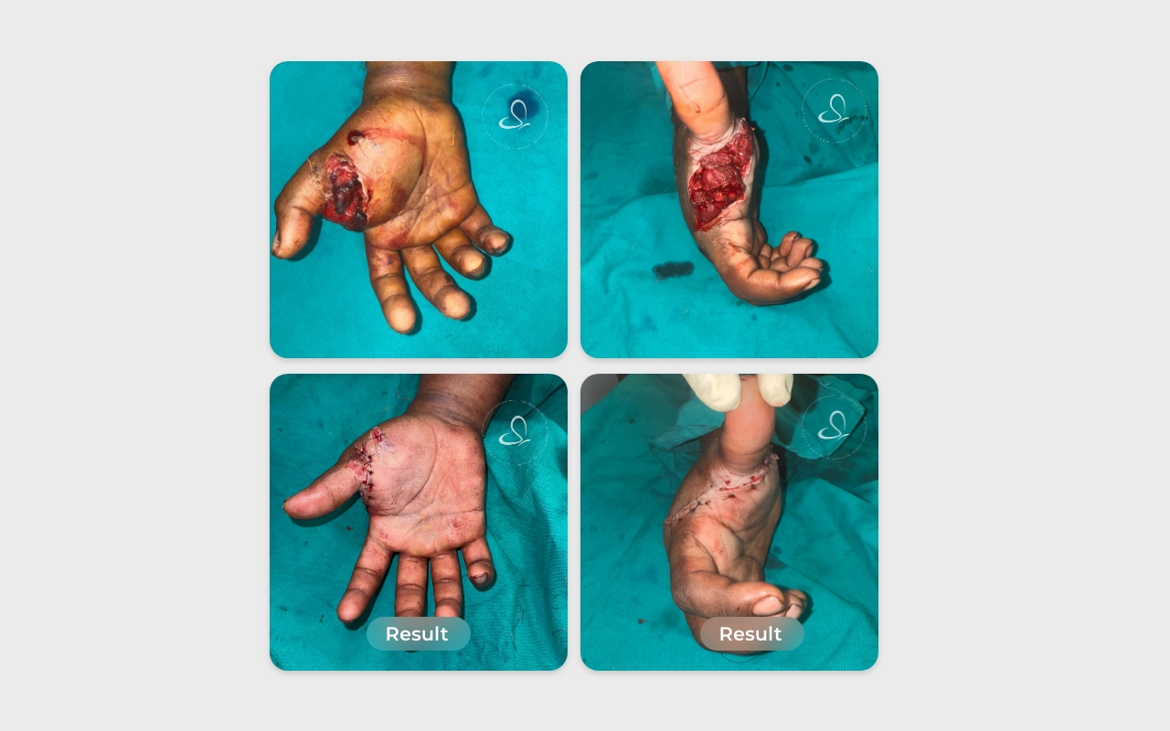 Hand injury reconstruction before after