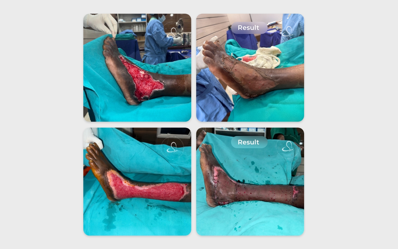 Skin grafting before after