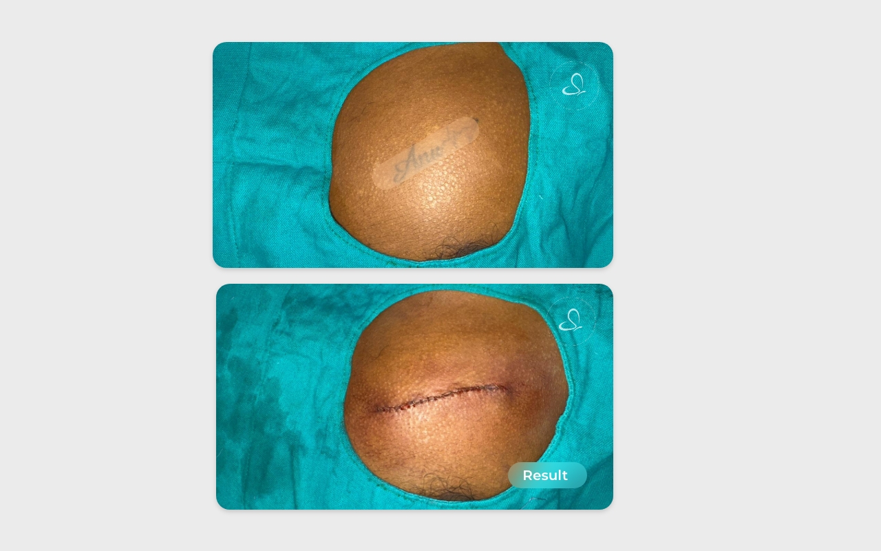 Surgical tattoo removal before after