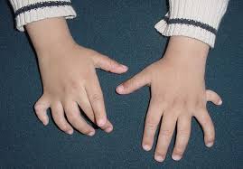 Congenital hand anomalies correction