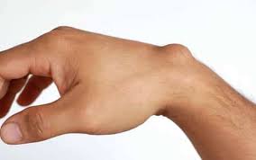 Lipoma cyst and ganglion surgery