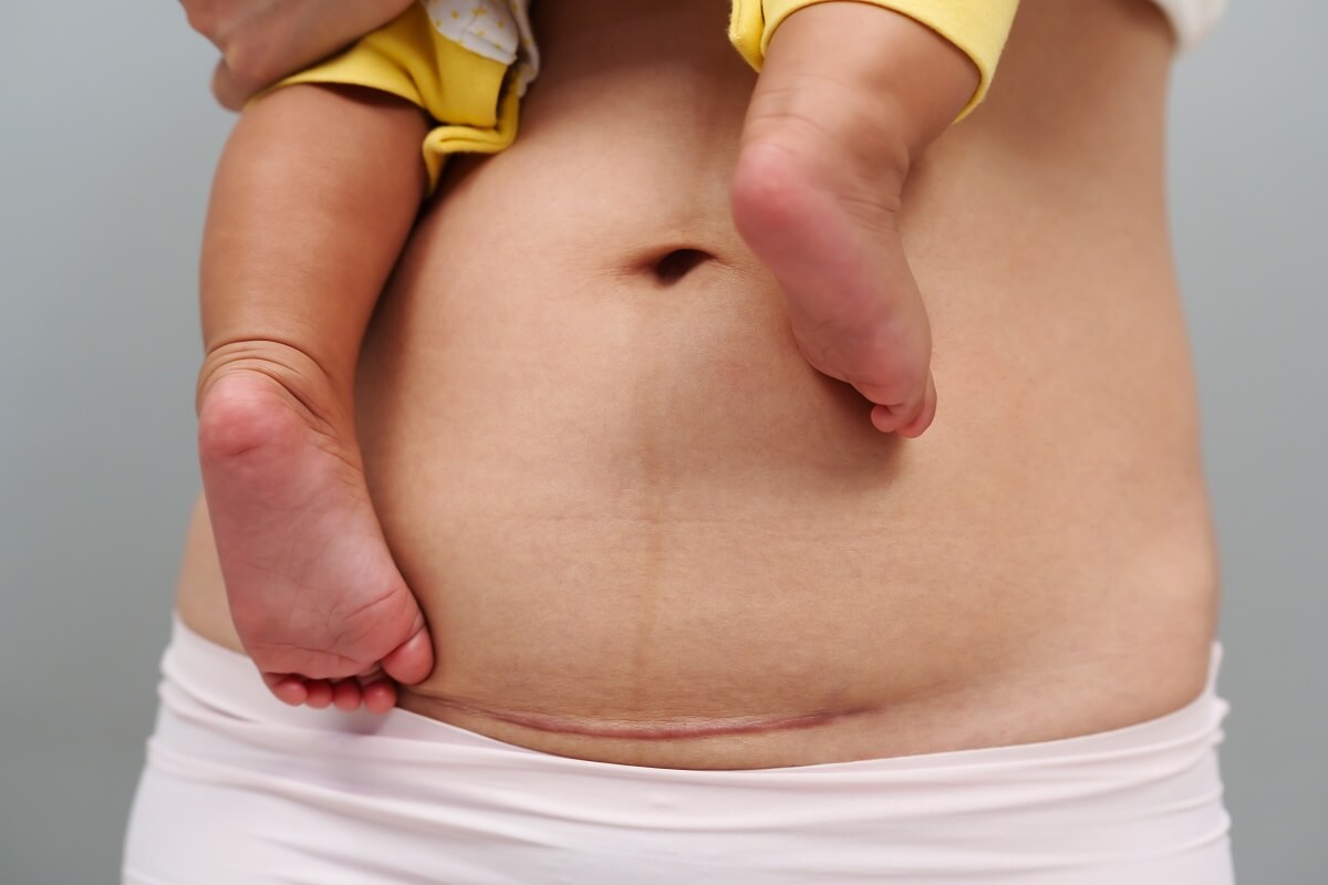 Post delivery reconstruction